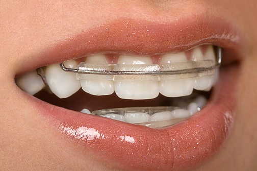 Ceramic Braces, Discreet Braces in Yorkshire