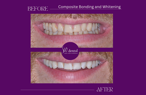 Composite Bonding and Whitening