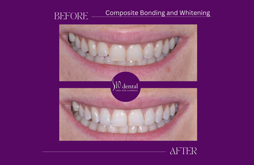 Composite Bonding and Whitening