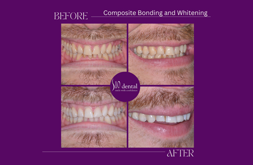 Composite Bonding and Whitening