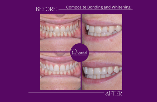 Composite Bonding and Whitening